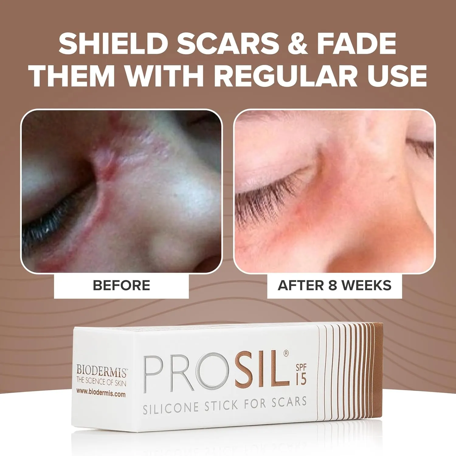 ProSil Silicone Scar Gel Stick with SPF 15 – Patented Scar Treatment in a Mess-Free, Compact Glide-On Stick - Made from Premium-Grade Silicone - Gentle on All Skin Types, Including Kids 4.25g