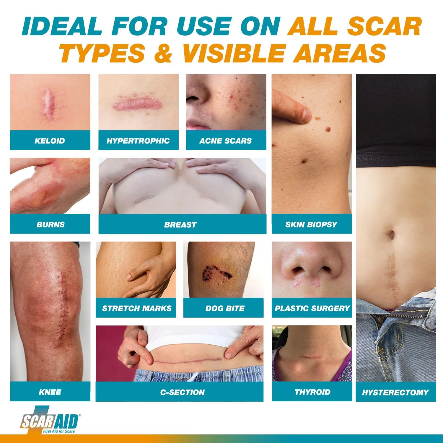 ScarAid SPF-15 Silicone Scar Gel Stick 4.25g – Mess-Free Scar Treatment with Sun Protection - Helps Improve the Look of Old & New Surgery, Injury & Acne Scars – Non-Toxic & Gentle on All Skin Types