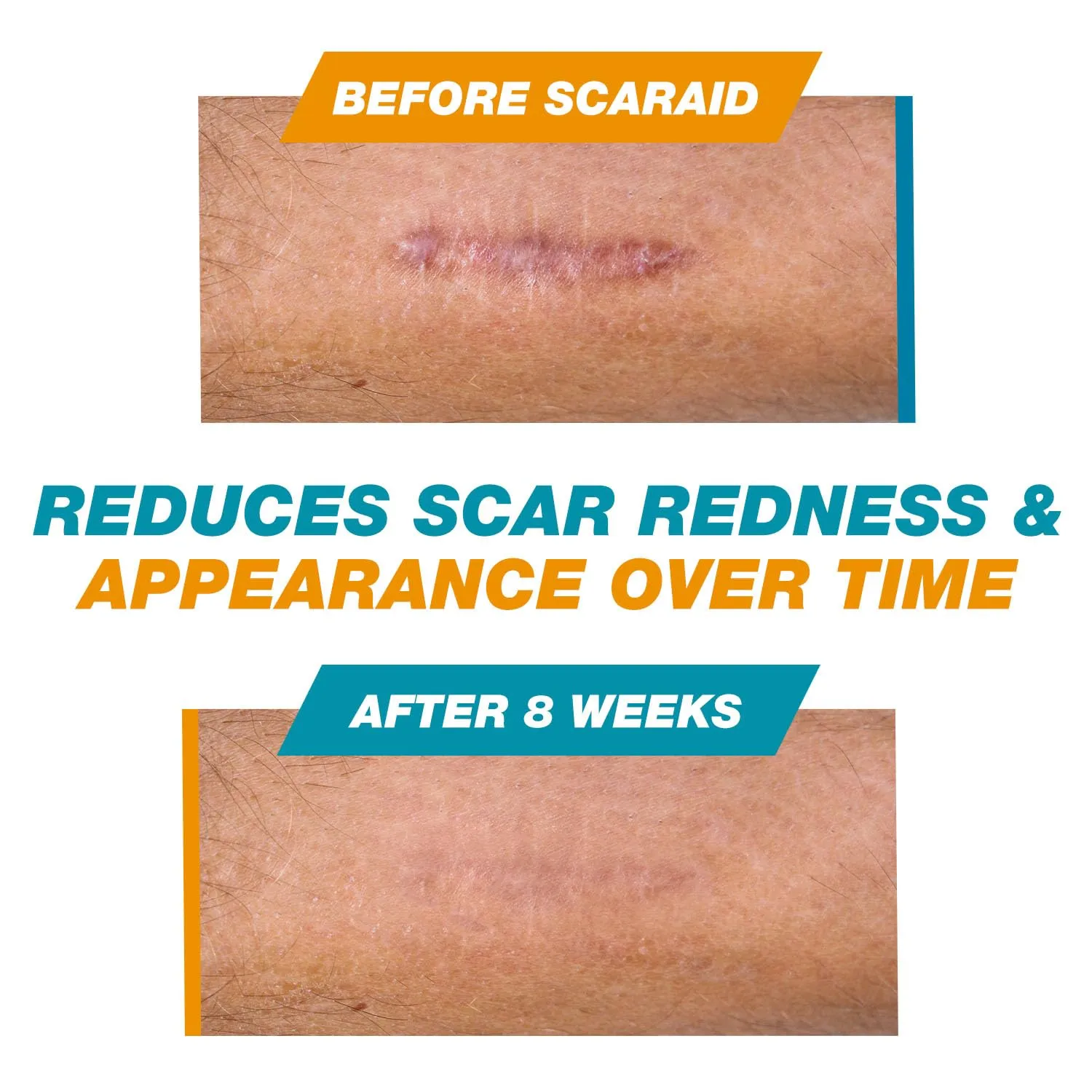 ScarAid SPF-15 Silicone Scar Gel Stick 4.25g – Mess-Free Scar Treatment with Sun Protection - Helps Improve the Look of Old & New Surgery, Injury & Acne Scars – Non-Toxic & Gentle on All Skin Types